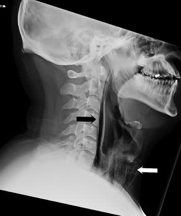 The unidentified 34-year-old man reported a popping sensation in his neck after he attempted to stifle a sneeze. (Photo: BMJ)