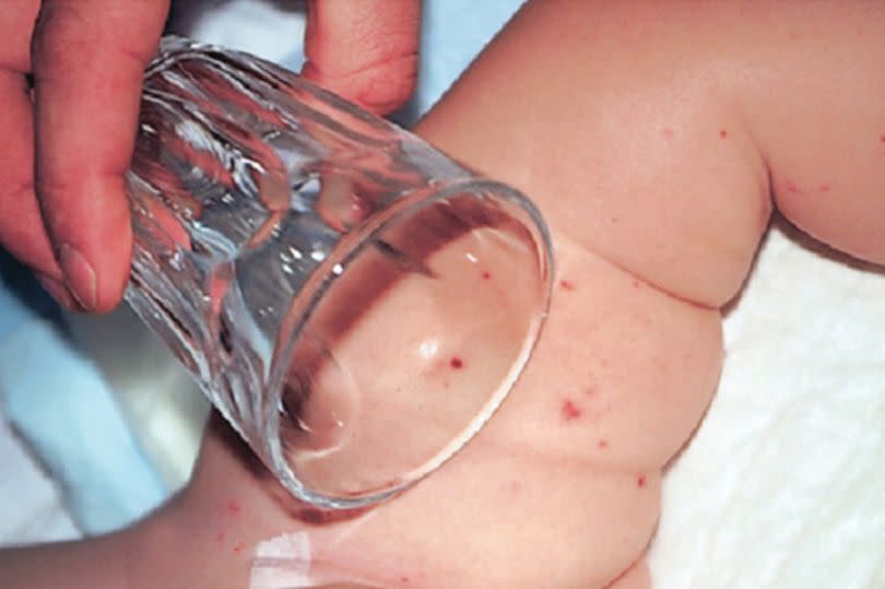 A typical meningitis rash will not blanch or fade when pressed with a glass