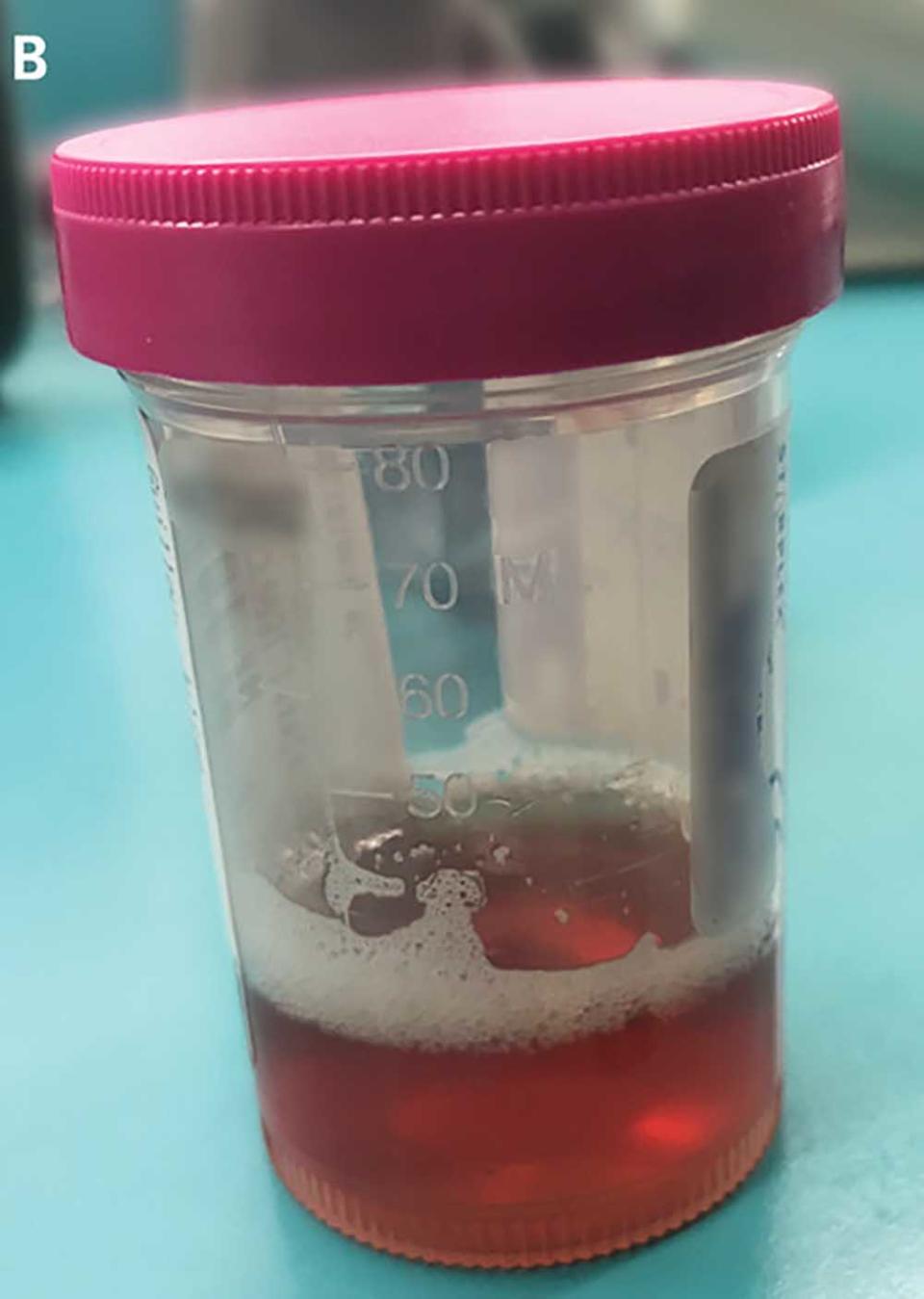 Discoloured urine is pictured in a vial.