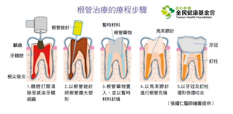 Root canal therapy course of treatment