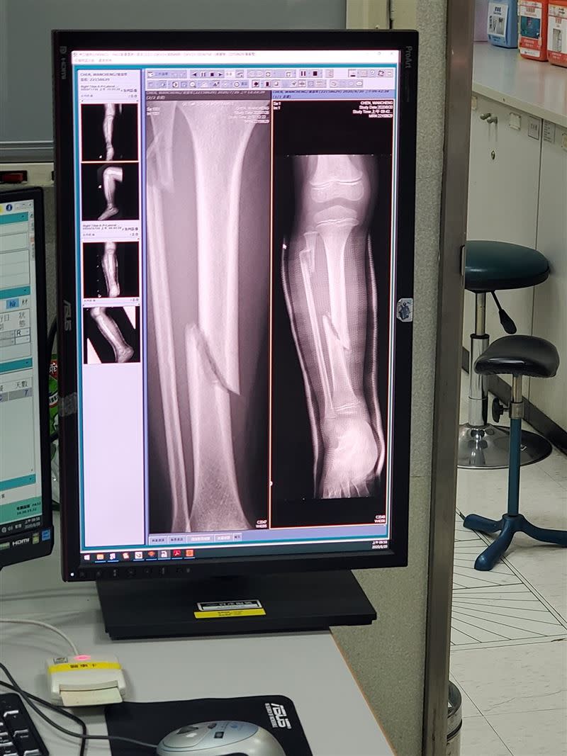 館長兒子的X光照，明顯看到小腿骨斷裂。（圖／翻攝自飆捍臉書）