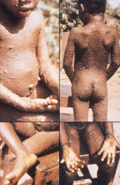 美國媒體爆料，武漢實驗室數月前曾做猴痘實驗。（圖／翻攝自美國CDC官網）