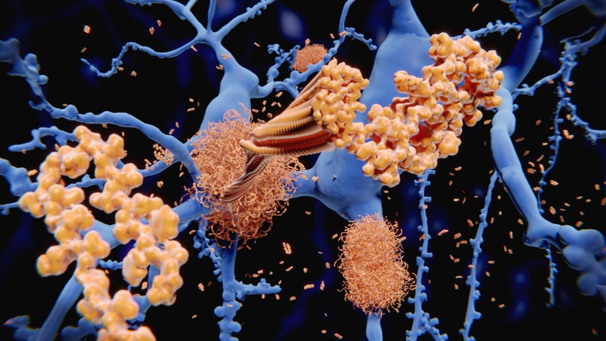  Illustration depicts amyloid-beta peptides, the building blocks of amyloid-beta plaques, building up in the brain among individual neurons. 