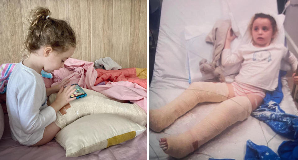 Girl with two broken legs in plaster