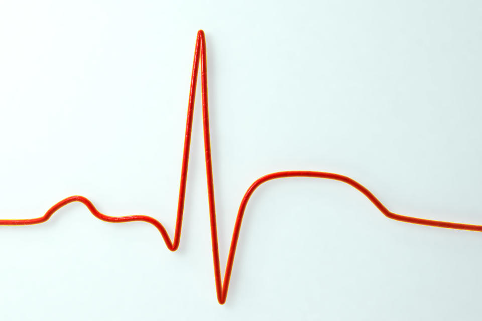 Electrocardiogram (ECG) during a myocardial infarction (heart attack). Computer illustration showing ST-elevation which is measured at the junctional or J-point.