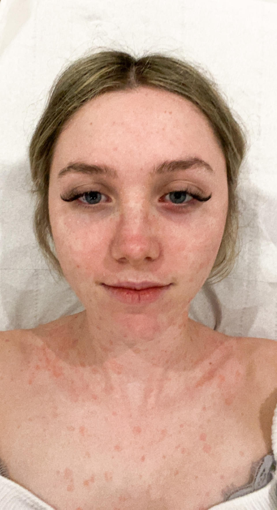 Rosie McKenzie with psoriasis on her face and neck. (Caters)