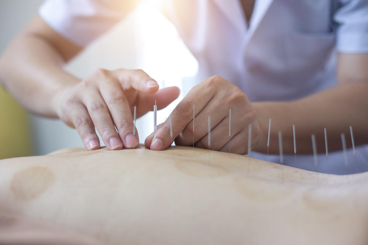 Traditional Chinese Medicine acupuncture.