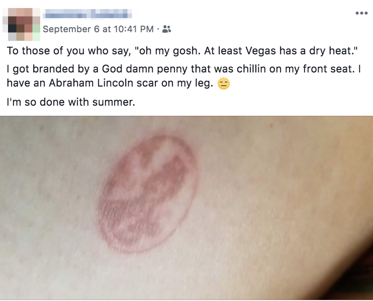 Burn of a penny on someone's leg