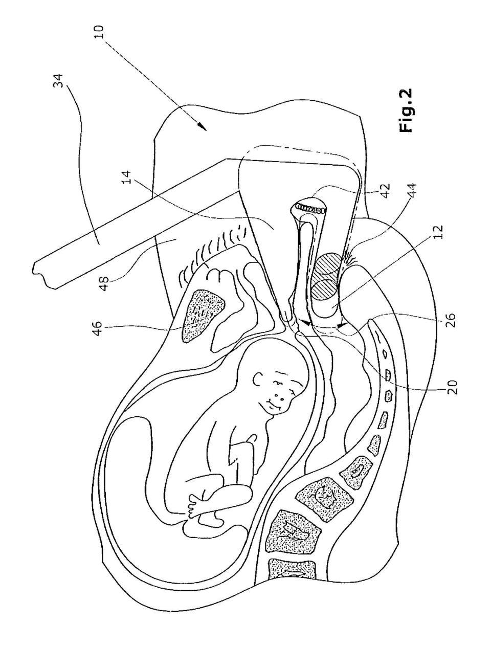 <p>So glücklich wie das Baby in der Zeichnung soll diese Erfindung auch die zukünftige Mutter machen. Es handelt sich um ein Massagegerät für Schwangere, welches Dammriss und Geburtstraumata vorbeugen soll. 2009 wurde die Idee vom Europäischen Patentamt durchgewunken. Die Erfinderin war ... (Bild: Google Patents)</p> 