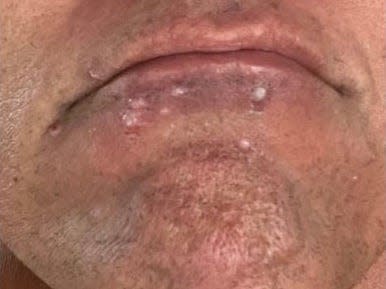 Steele's lesions are shown on July 11. They are pimple-like.