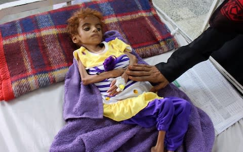 A Yemeni child suffering from malnutrition receives treatment at a hospital in the northern district of Abs, in Yemen's Hajjah province. - Credit: AFP