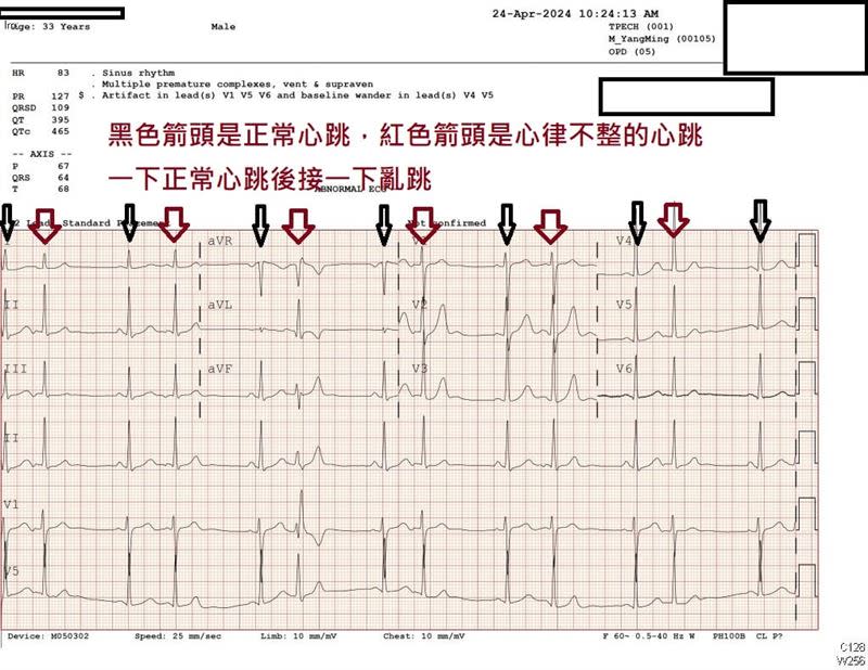 看完30歲男性的心電圖後，蘇一峰表示「強震震出心律不整」。（圖／翻攝自蘇一峰臉書）