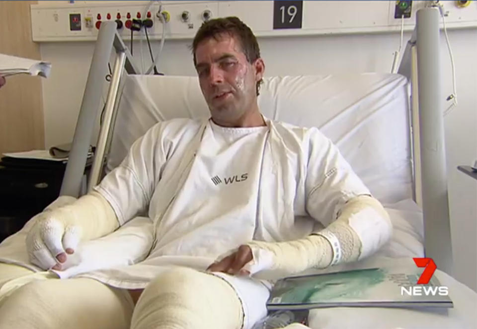 Torquay Brent Dixon (pictured) has burns to 14 per cent of his body after he was injured by an exploding aerosol can. 