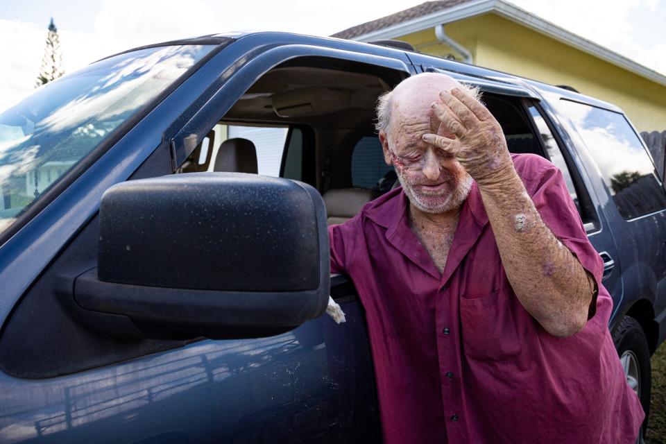 Philip Boswell, who suffers from squamous cell carcinoma, takes a moment as he changes the bandage on one of his wounds outside the vehicle he lives in near West Palm Beach.