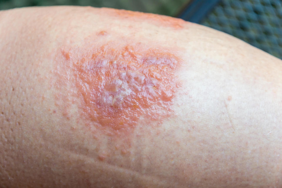 Poison Ivy rash and blisters on a leg (Alamy)