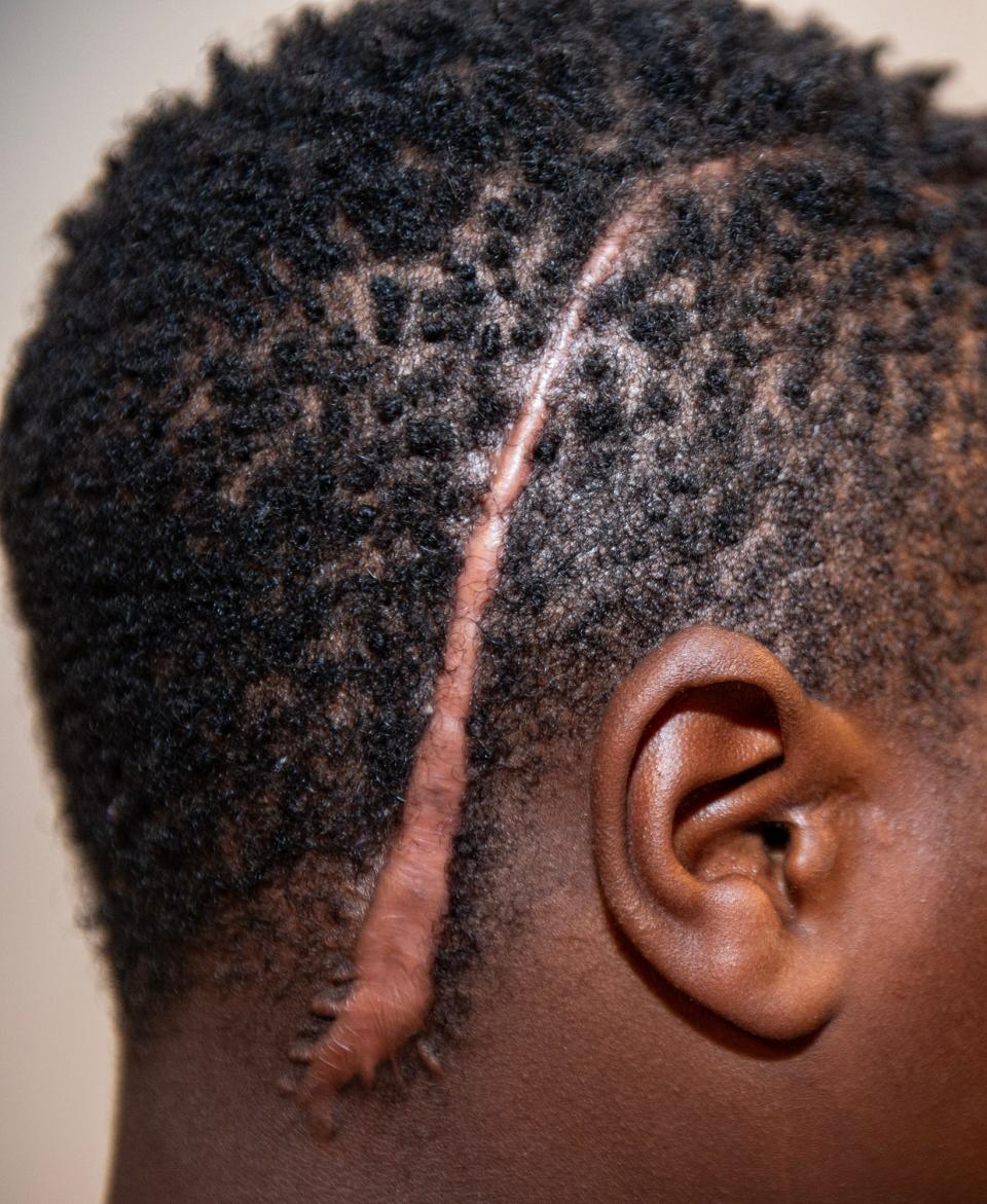 Jimmy Lee Kelly III, seen on Friday, Nov. 10, has a scar on his head from surgery he had to undergo after contracting meningitis in Jackson. The family thinks the meningitis was related to the sewage that was in their home.