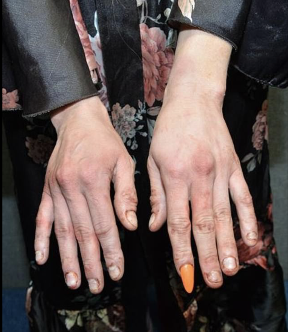 Courtney Clenney’s blood-stained hands and fingernails after the 3 April stabbing (Miami-Dade Prosecutor’s Office)