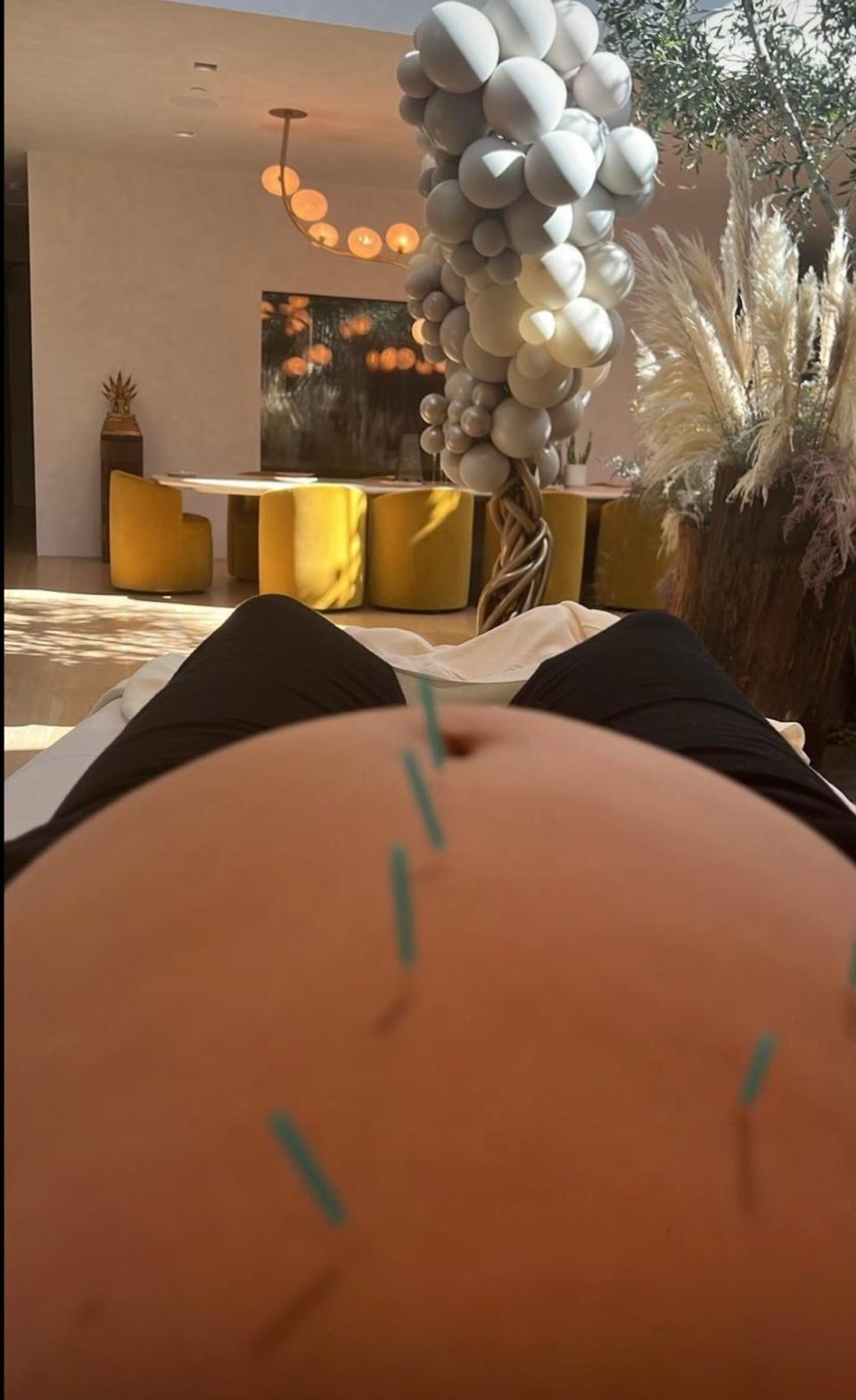 Chrissy Teigen had acupunture session in the comfort of her living room (Instagram)