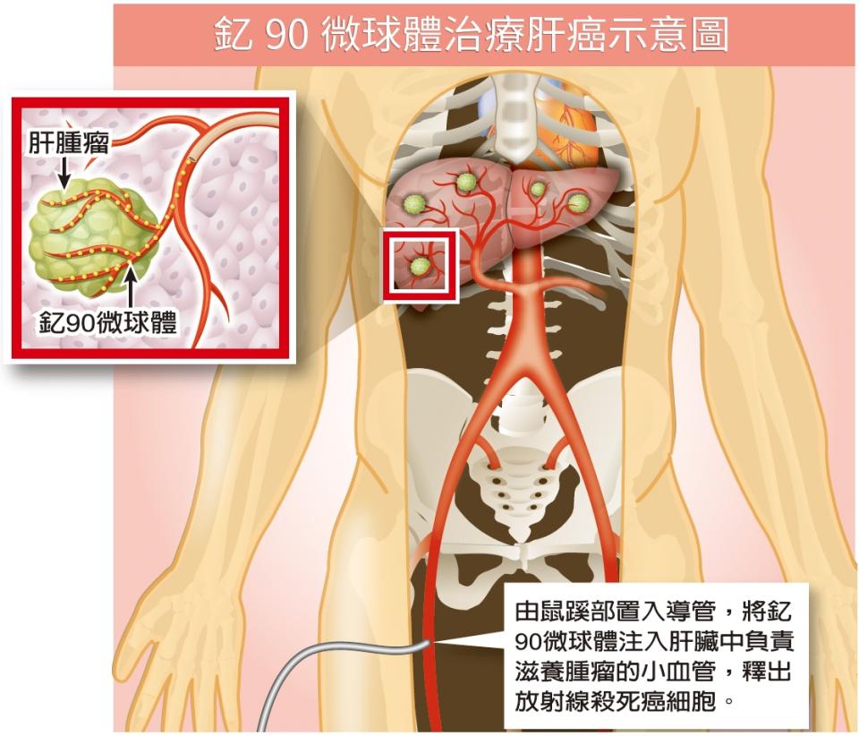 釔90微球體治療肝癌示意圖