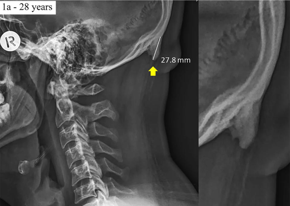 X-ray shows external occipital protuberance: A 28mm horn was found on the back of a 28-year-old's skull, linked to smartphone use.