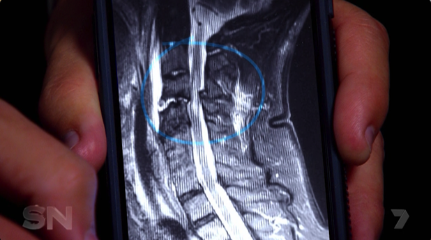 A scan of the fractures in John's spine