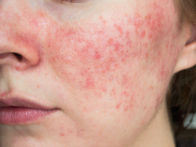 Rosacea on someone's skin.