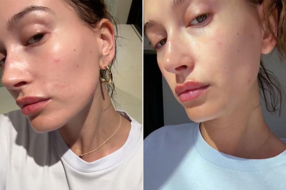 <p>TikTok/haileybieber</p> Hailey Bieber details her experience with Perioral dermatitis in new TikTok video.