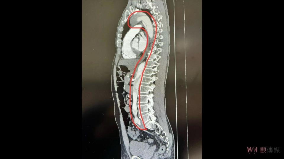 ▲員榮醫療體系員榮醫院急診部主任朱偉岳，從電腦斷層掃描發現患者整條主動脈(圖中紅線圈處)都有嚴重剝離的情況，隨即安排患者接受手術。（員榮醫院提供）