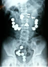 An undated X-ray shows steel balls and magnets inside of 8-year-old Haley Lents, after the Huntingburg, Ind. child swallowed the pieces from a magnetic toy set on May 8, 2008. The child required emergency surgery and was hospitalized for two weeks. (AP Photo/The Jaspaar Herald)