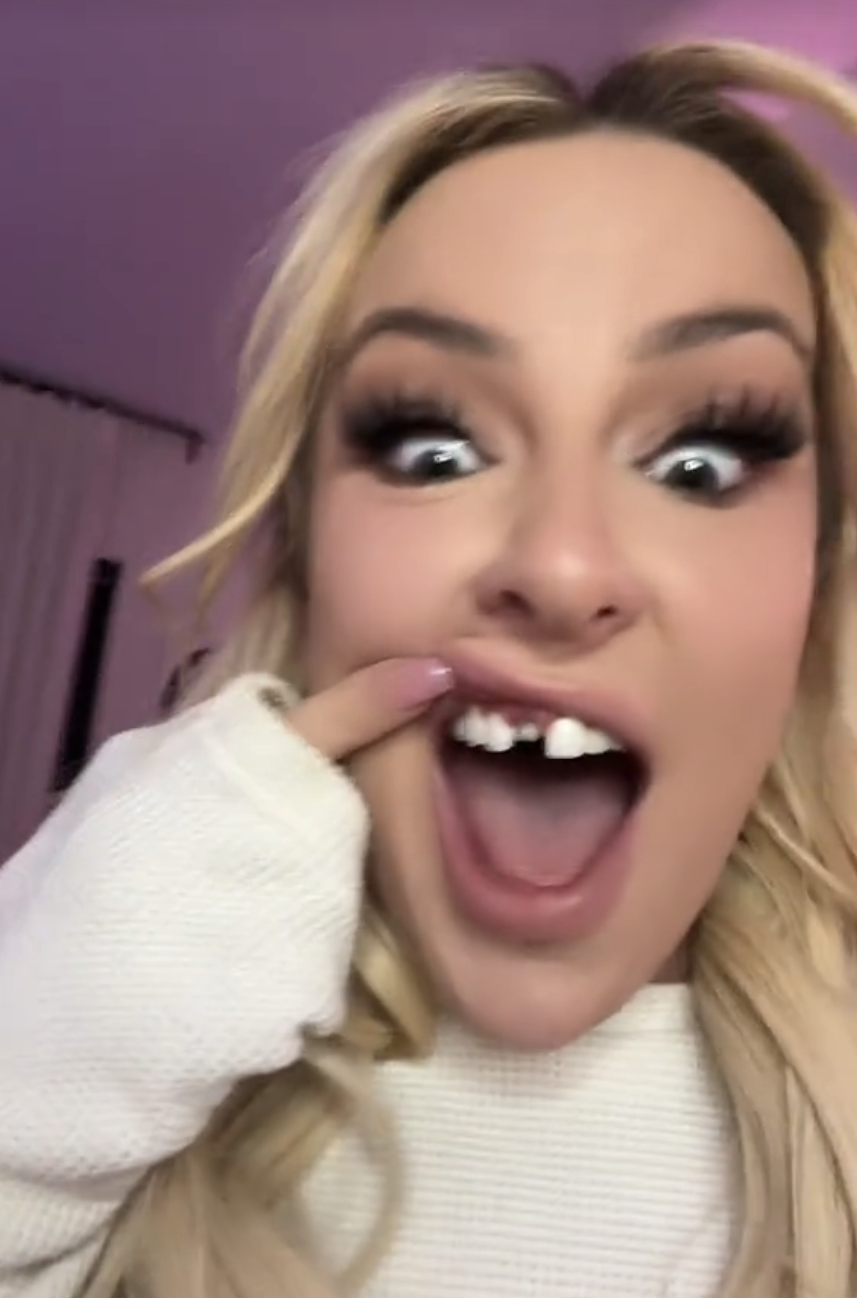 Tana lifting her upper lip to reveal the space where the veneer was