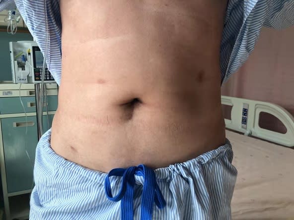 嘉基達文西手術肛門保位戰　大腸直腸癌傷口少又小還保肛