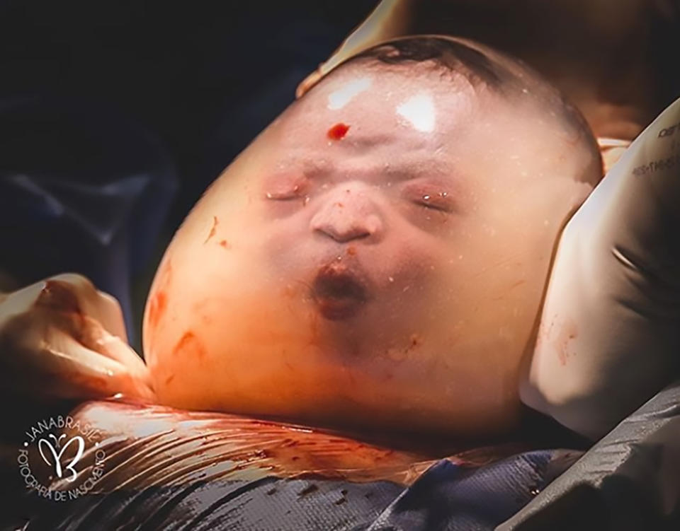 Noah was born inside his fluid-filled amniotic sac in a hospital in Brazil. Source: CEN/ Australscope