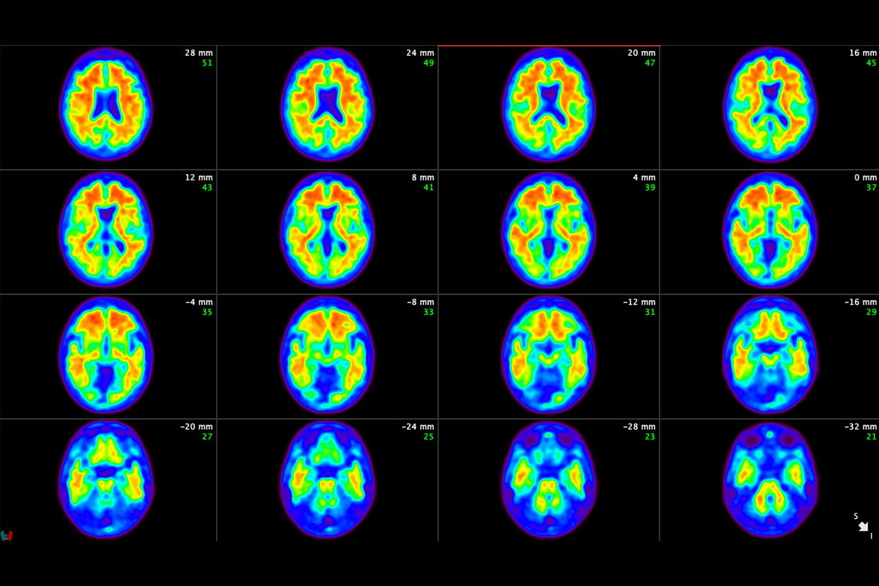 Brain scans from a patient in the clinical trials of donanemab show amyloid plaque being removed from the patient’s brain. (Eli Lilly via The New York Times)