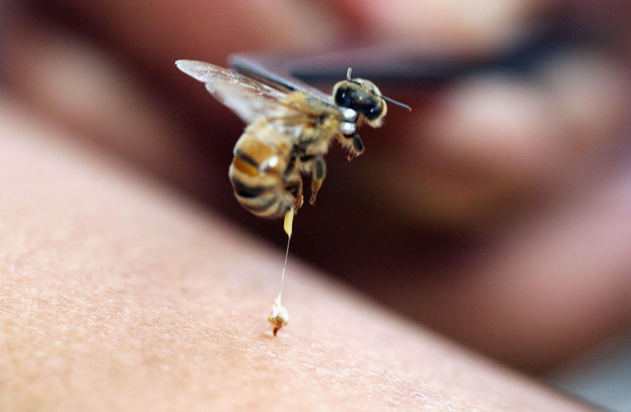 Bee acupuncture, or apitherapy, is an alternative healing practice whereby bee stings are used as treatment for various conditions and diseases. (Photo: Dimas Ardian/Getty Images)