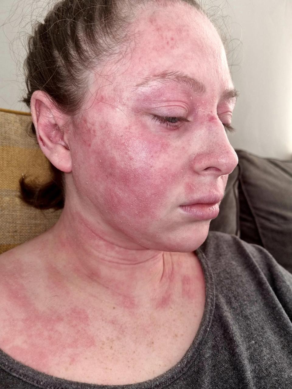 La dermatitis atópica de Kimberley le cubrió la cara y el cuello en marzo de 2020 (Collect/PA Real Life)