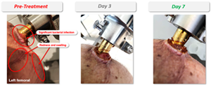 Prior to treatment with R327G, the patient showed significant bacterial infection, redness, and swelling around the implant in the upper left thigh. Three days after applying R327G, the initial redness and swelling had minimized, with the wound healing and drying up. On day 14, the wound dried up and had improved with no signs of redness or swelling. When applied daily, R327G treatment was shown to be well tolerated.