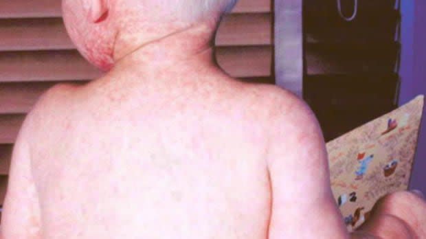 The rash associated with measles usually appears about 14 days after infection, or about three to seven days after other initial symptoms begin. The rash typically begins on the face, then spreads to the trunk of the body, arms and legs. It usually lasts four to seven days. (CBC - image credit)