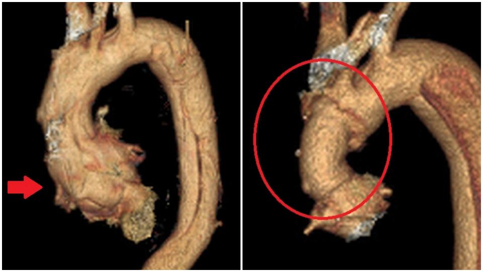 左圖紅色箭頭標示為術前昇主動脈剝離部分；右圖紅圈處為人工血管置換接合後的昇主動脈。