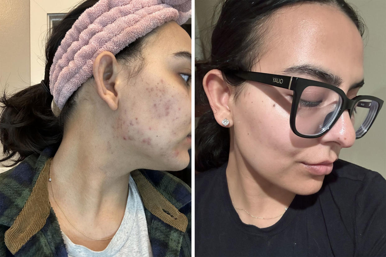 Before and after JJ Boparai started taking spironolactone to treat her acne. (JJ Boparai)