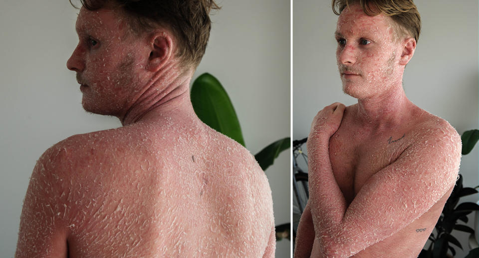 Jordan Hendey displays the peeling skin on his back and arms.