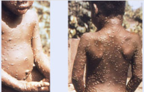 Symptoms of monkeypox include mild to severe flulike illness and a rash with pustules, which can look like blisters.