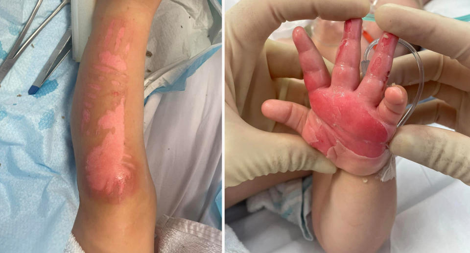 Burns on toddler's hands and legs. 