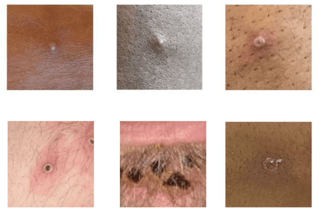 <p>UK Health Security Agency / CDC</p> Six different manifestations of monkeypox lesions