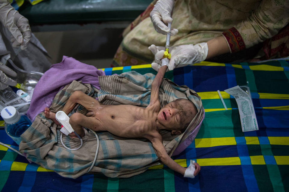 <p>A severely malnourished, premature 15 day old baby gets treated in the pediatric-neonatal unit at the ‘Doctors Without Borders’ Kutupalong clinic on October 4, 2017, in Cox’s Bazar, Bangladesh. (Photograph by Paula Bronstein/Getty Images) </p>