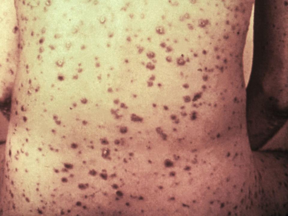 Secondary syphilis rash on back