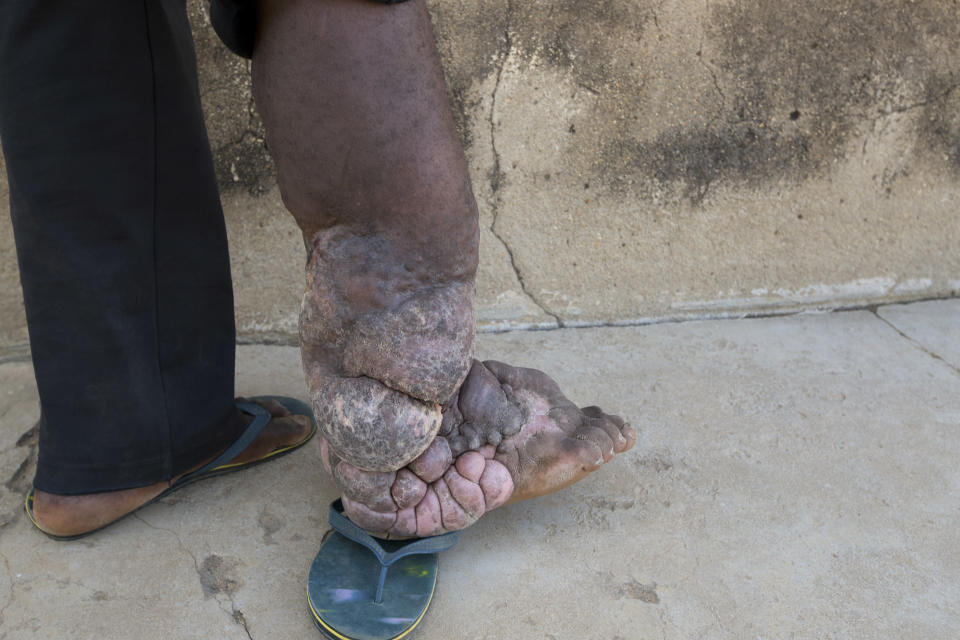 A man in Nigeria with severe elephantiasis. (Photo: The Carter Center / T Saater)