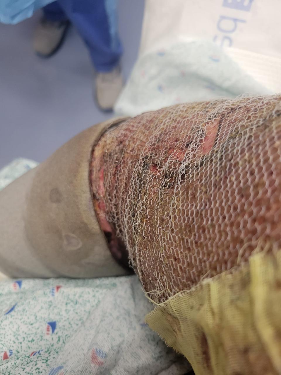 Kahlil Floyd's arm after a skin graft on Sept. 16, two weeks after his Plum Pit Food Truck was struck by a car in Wilmington as he fried empanadas.