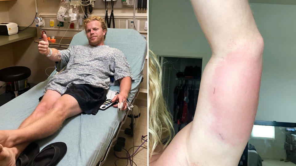 Florida man Tyler King in a hospital bed giving a thumbs up on the left and on the right is his arm with the rash spreading.