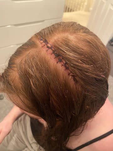 <p>Laura Mahon</p> Laura Mahon's scar from brain surgery.