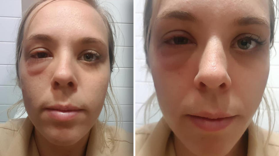 Em Lee believes leftover nut residue on board a domestic Jetstar flight was responsible for her ‘minor’ allergic reaction. Images: Facebook/Em Lee